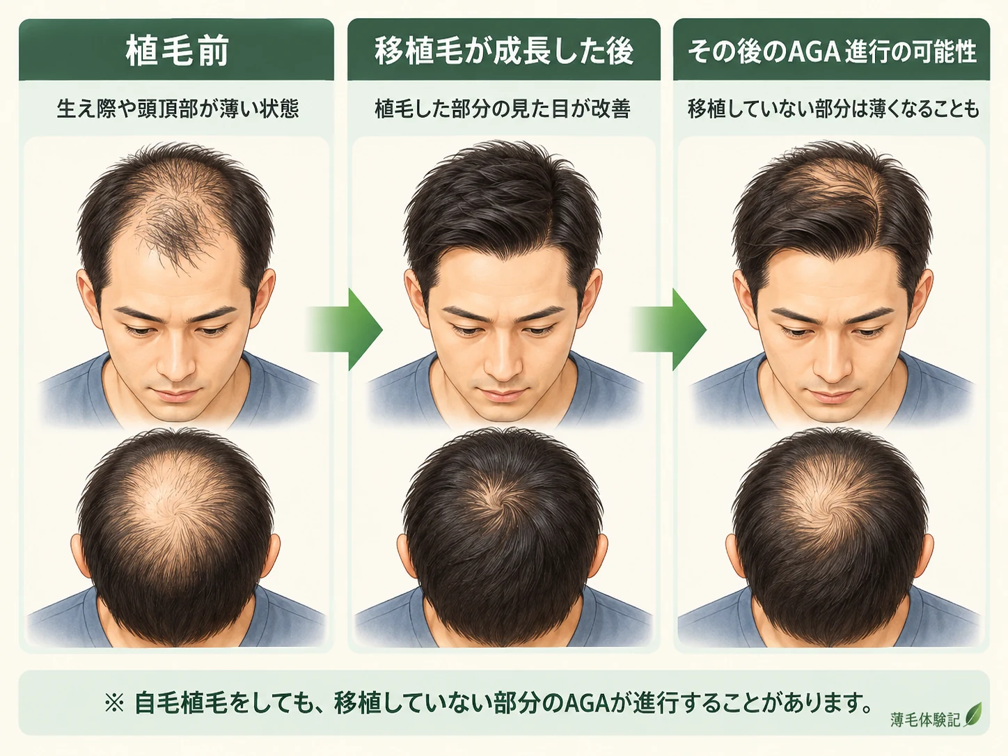 自毛植毛前、移植毛が成長した後、植毛していない部分のAGAが進行した場合を比較した模式図